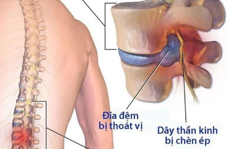 Thoát vị đĩa đệm cột sống điều trị đông y hay tây y