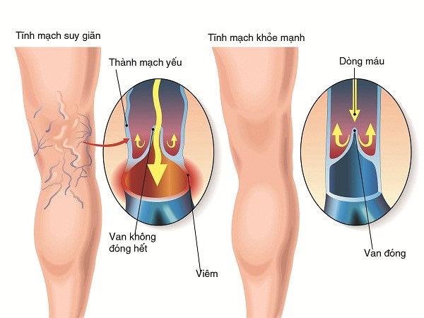 Đông y và Suy dãn tĩnh mạch chi dưới